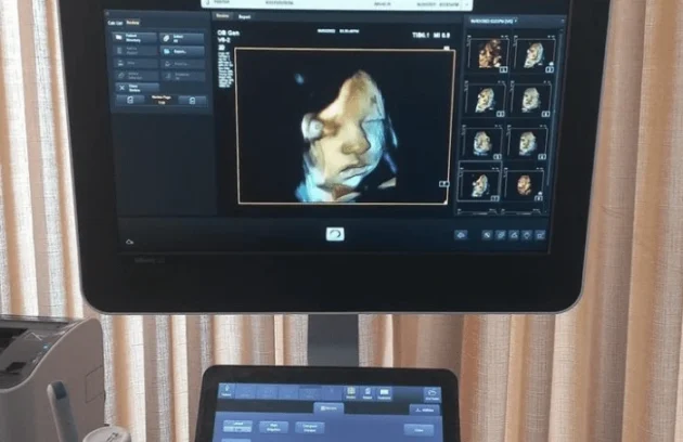 Clear 3D ultrasound photo showing baby’s facial features