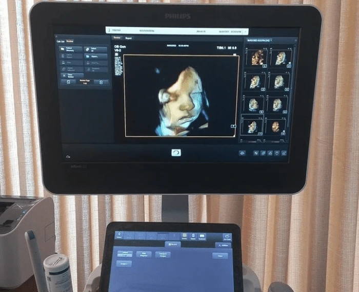 Clear 3D ultrasound photo showing baby’s facial features
