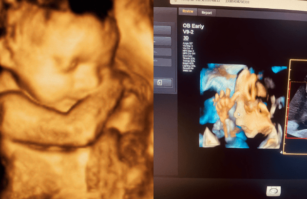 3d-4d-ultrasound-in-kathmandu