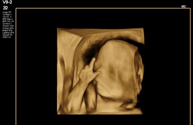 Comparison between 3D and 4D ultrasound photos for clarity