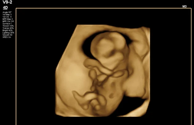 Parents viewing the best 3D/4D ultrasound results on screen.