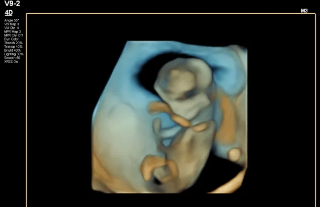 Parents viewing the best 3D/4D ultrasound results on screen.