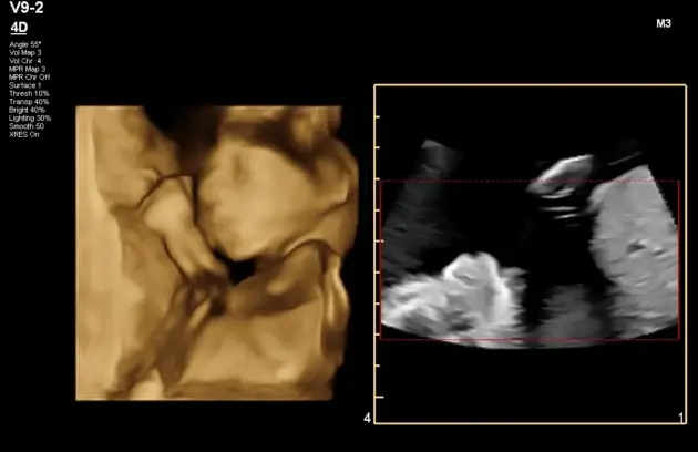 3D Anomaly Scan in Nepal