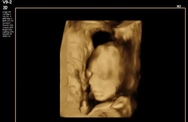 4D Anomaly Scan in Nepal