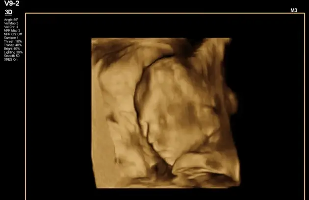Anomaly Scan in Nepal
