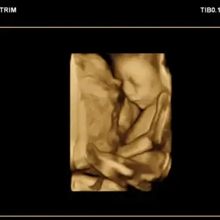 Pregnancy Ultrasound in Thapathali