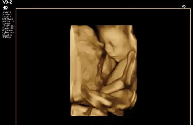 Pregnancy Ultrasound in Thapathali